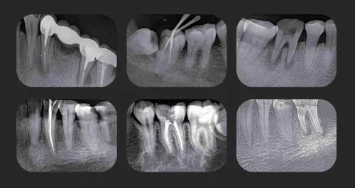 RTG X-line XDI-150 + Skaner płytek Fussen F200 26050489_101195.webp