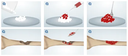 Syntetyczny materiał kościotwórczy VCP instruções_ortho.png